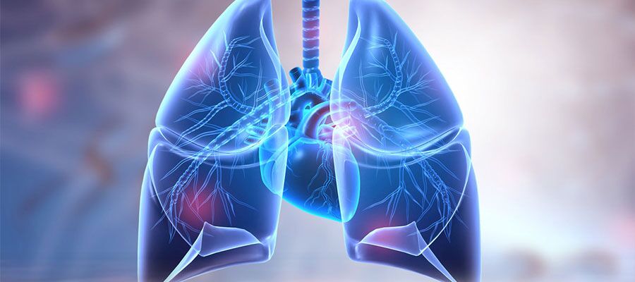 Qu'est-ce qui cause l'accumulation de liquide dans les poumons ? - Aktif  International HospitalAktif International Hospital